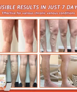 Zvoevo® Vein Ease Microneedle Care Patch