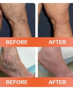 Zvoevo® Vein Ease Microneedle Care Patch