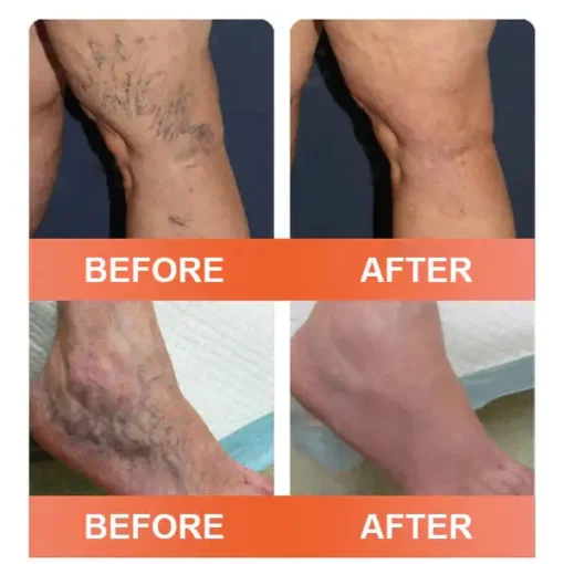 Zvoevo® Vein Ease Microneedle Care Patch
