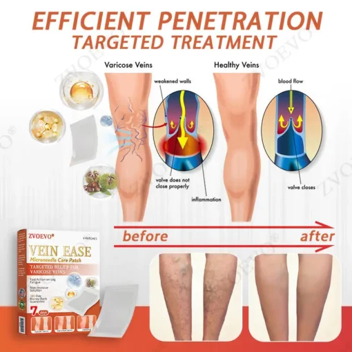 Zvoevo® Vein Ease Microneedle Care Patch