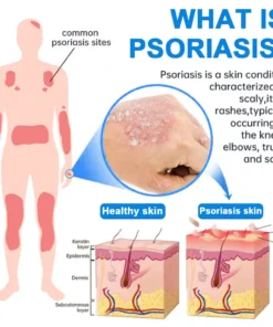 Zvoevo®Magnesium Herbal Psoriasis Spray
