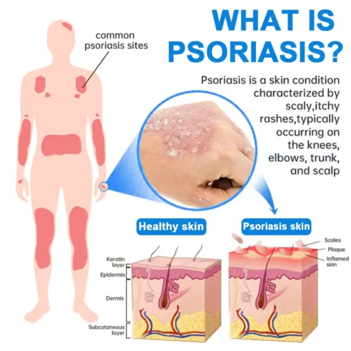 Zvoevo®Magnesium Herbal Psoriasis Spray