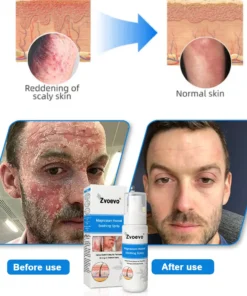 Zvoevo®Magnesium Herbal Psoriasis Spray