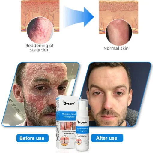 Zvoevo®Magnesium Herbal Psoriasis Spray