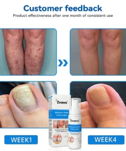 Zvoevo®Magnesium Herbal Psoriasis Spray