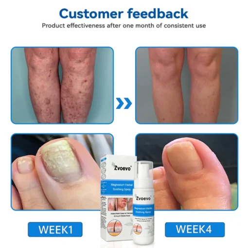 Zvoevo®Magnesium Herbal Psoriasis Spray