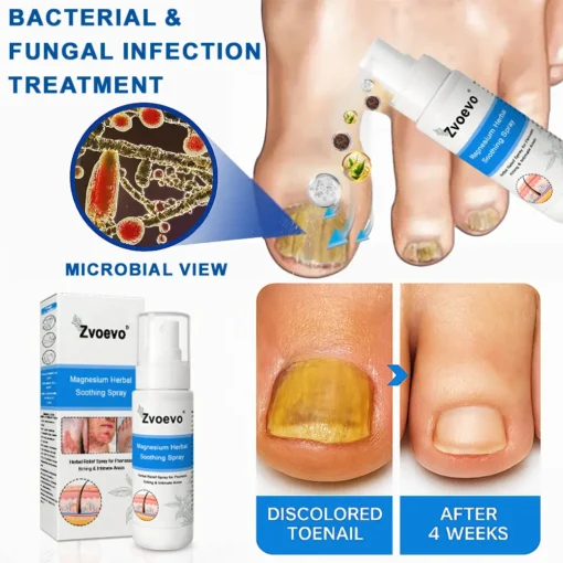 Zvoevo®Magnesium Herbal Psoriasis Spray