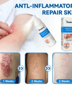 Zvoevo®Magnesium Herbal Psoriasis Spray