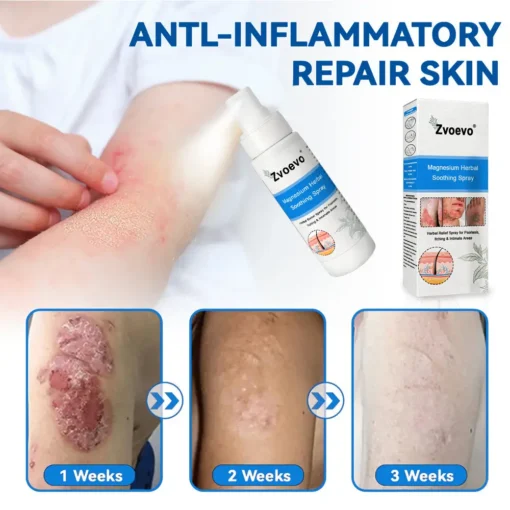 Zvoevo®Magnesium Herbal Psoriasis Spray