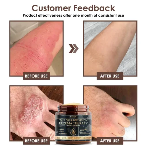 𝐙𝐯𝐨𝐞𝐯𝐨® 𝐓𝐚𝐥𝐥𝐨𝐰 𝐁𝐞𝐞 𝐕𝐞𝐧𝐨𝐦 𝐒𝐤𝐢𝐧 𝐑𝐞𝐬𝐭𝐨𝐫𝐚𝐭𝐢𝐨𝐧 𝐂𝐫𝐞𝐚𝐦