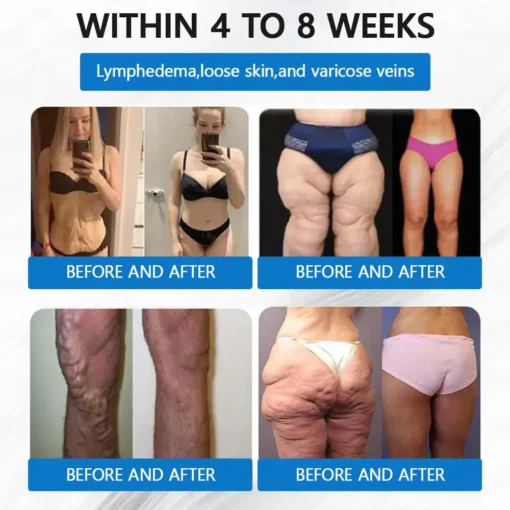 ZVOEVO® SMGT-GLP-1 𝐓𝐢𝐫𝐳𝐞𝐩𝐚𝐭𝐢𝐝𝐞 & 𝐂𝐨𝐥𝐥𝐚𝐠𝐞𝐧 𝐍𝐚𝐧𝐨 𝐌𝐢𝐜𝐫𝐨𝐧𝐞𝐞𝐝𝐥𝐞 𝐖𝐞𝐢𝐠𝐡𝐭 𝐋𝐨𝐬𝐬 𝐏𝐚𝐭𝐜𝐡