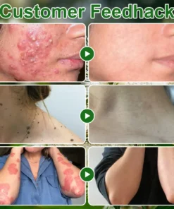 ๐ณ๐ฏ๐จ๐๐ฏ๐จยฎ ๐๐๐ ๐๐ซ๐๐ ๐๐ข๐ฅ ๐๐ค๐ข๐ง ๐๐ซ๐๐๐ญ๐ฆ๐๐ง๐ญ ๐๐ซ๐๐๐ฆ