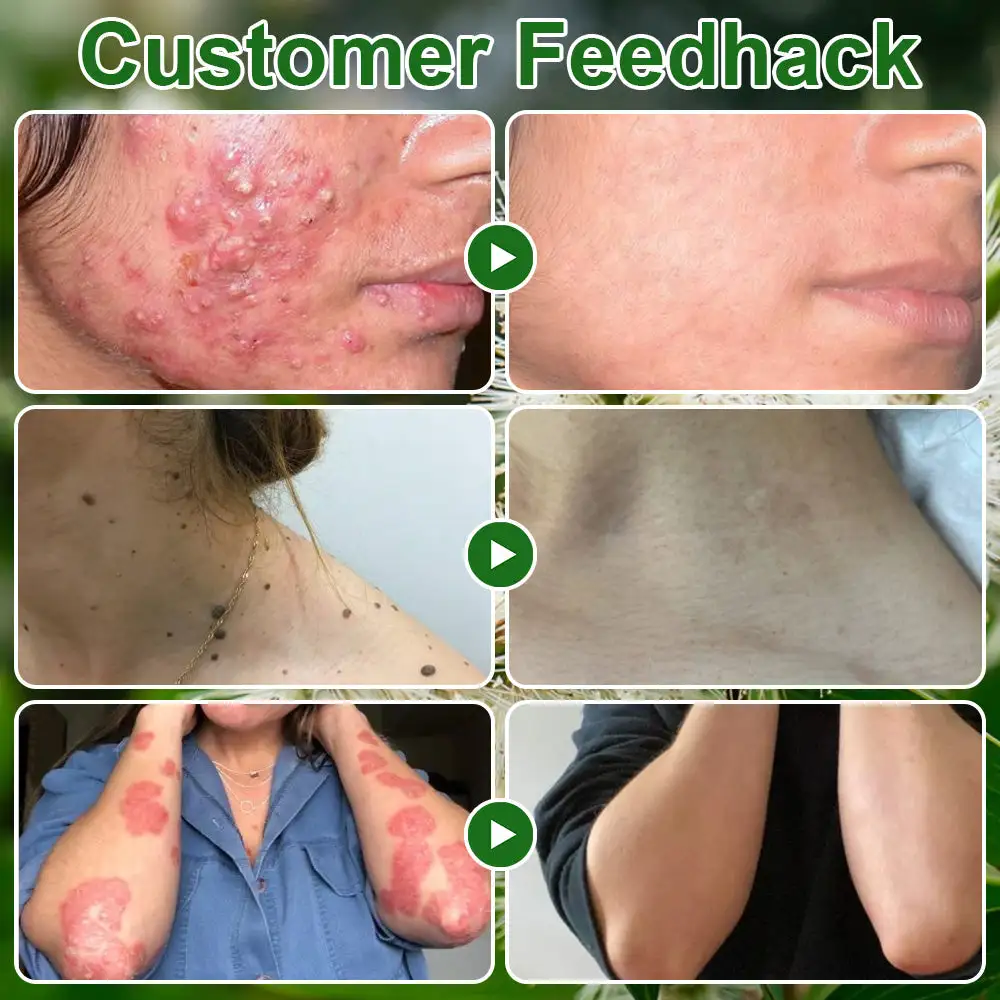 ๐ณ๐ฏ๐จ๐๐ฏ๐จยฎ ๐๐๐ ๐๐ซ๐๐ ๐๐ข๐ฅ ๐๐ค๐ข๐ง ๐๐ซ๐๐๐ญ๐ฆ๐๐ง๐ญ ๐๐ซ๐๐๐ฆ