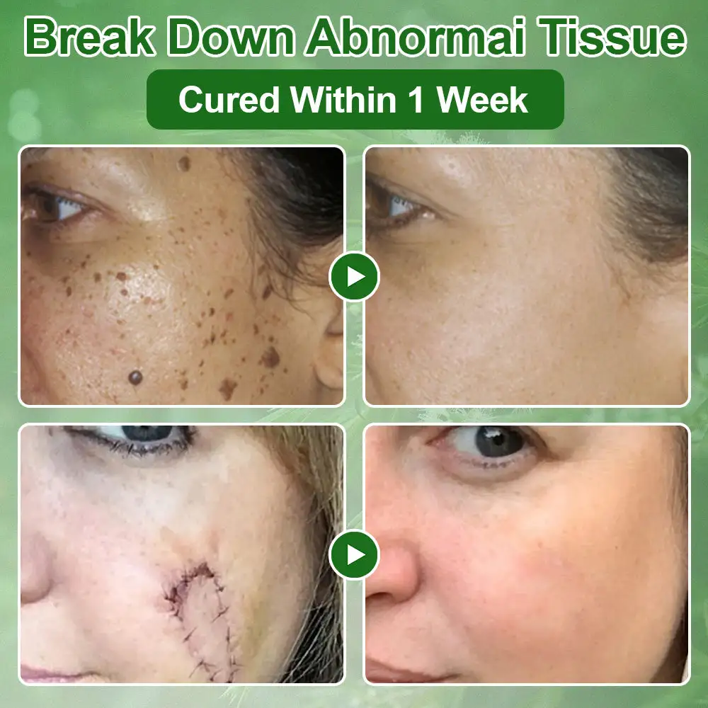 ๐ณ๐ฏ๐จ๐๐ฏ๐จยฎ ๐๐๐ ๐๐ซ๐๐ ๐๐ข๐ฅ ๐๐ค๐ข๐ง ๐๐ซ๐๐๐ญ๐ฆ๐๐ง๐ญ ๐๐ซ๐๐๐ฆ