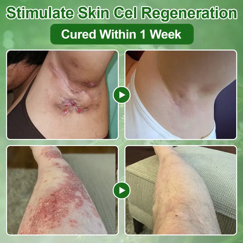 ๐ณ๐ฏ๐จ๐๐ฏ๐จยฎ ๐๐๐ ๐๐ซ๐๐ ๐๐ข๐ฅ ๐๐ค๐ข๐ง ๐๐ซ๐๐๐ญ๐ฆ๐๐ง๐ญ ๐๐ซ๐๐๐ฆ