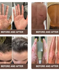 𝐙𝐯𝐨𝐞𝐯𝐨® 𝐌𝐮𝐥𝐭𝐢-𝐒𝐲𝐦𝐩𝐭𝐨𝐦 𝐏𝐬𝐨𝐫𝐢𝐚𝐬𝐢𝐬 & 𝐄𝐜𝐳𝐞𝐦𝐚 𝐓𝐫𝐞𝐚𝐭𝐦𝐞𝐧𝐭 𝐂𝐫𝐞𝐚𝐦