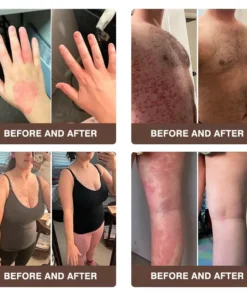 𝐙𝐯𝐨𝐞𝐯𝐨® 𝐌𝐮𝐥𝐭𝐢-𝐒𝐲𝐦𝐩𝐭𝐨𝐦 𝐏𝐬𝐨𝐫𝐢𝐚𝐬𝐢𝐬 & 𝐄𝐜𝐳𝐞𝐦𝐚 𝐓𝐫𝐞𝐚𝐭𝐦𝐞𝐧𝐭 𝐂𝐫𝐞𝐚𝐦