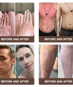 𝐙𝐯𝐨𝐞𝐯𝐨® 𝐌𝐮𝐥𝐭𝐢-𝐒𝐲𝐦𝐩𝐭𝐨𝐦 𝐏𝐬𝐨𝐫𝐢𝐚𝐬𝐢𝐬 & 𝐄𝐜𝐳𝐞𝐦𝐚 𝐓𝐫𝐞𝐚𝐭𝐦𝐞𝐧𝐭 𝐂𝐫𝐞𝐚𝐦