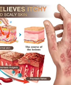 𝐙𝐯𝐨𝐞𝐯𝐨® 𝐌𝐮𝐥𝐭𝐢-𝐒𝐲𝐦𝐩𝐭𝐨𝐦 𝐏𝐬𝐨𝐫𝐢𝐚𝐬𝐢𝐬 & 𝐄𝐜𝐳𝐞𝐦𝐚 𝐓𝐫𝐞𝐚𝐭𝐦𝐞𝐧𝐭 𝐂𝐫𝐞𝐚𝐦