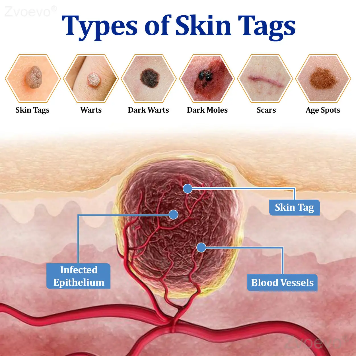 Zvoevo® BeeDerm RX Cream