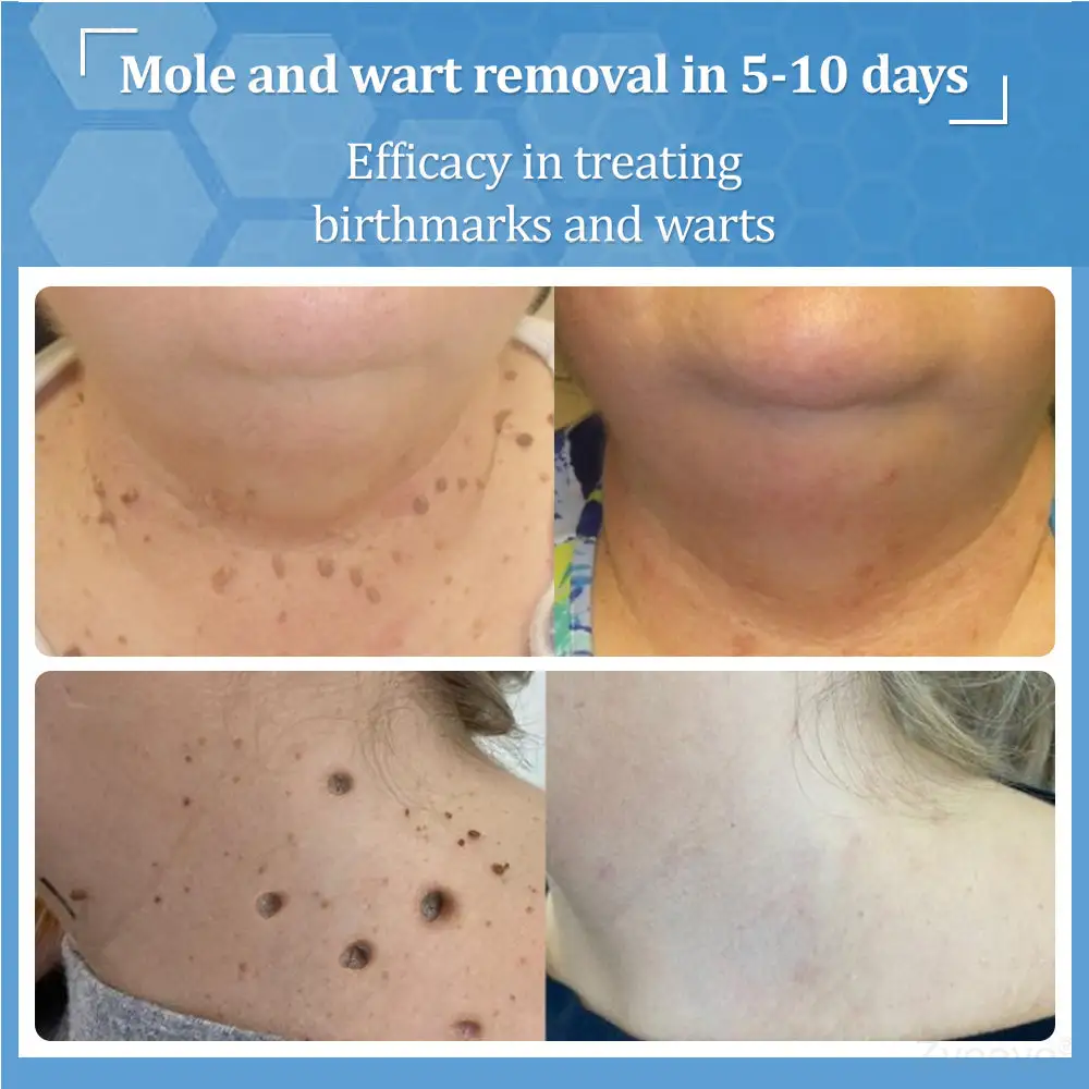 Zvoevo® BeeDerm RX Cream