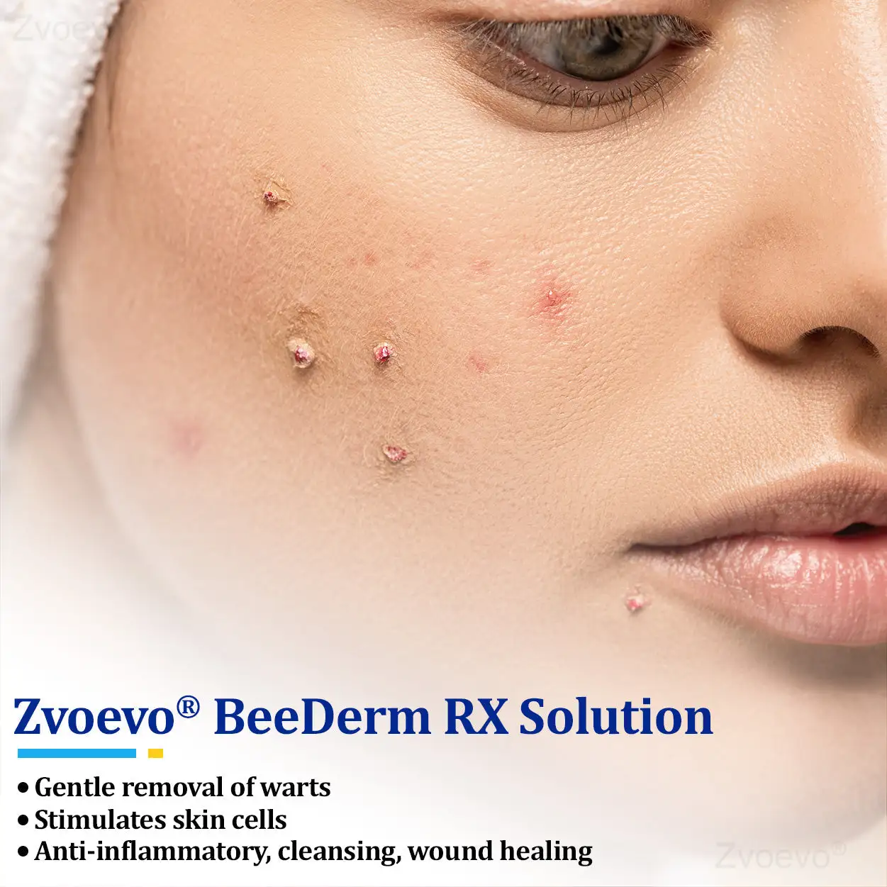 Zvoevo® BeeDerm RX Solution