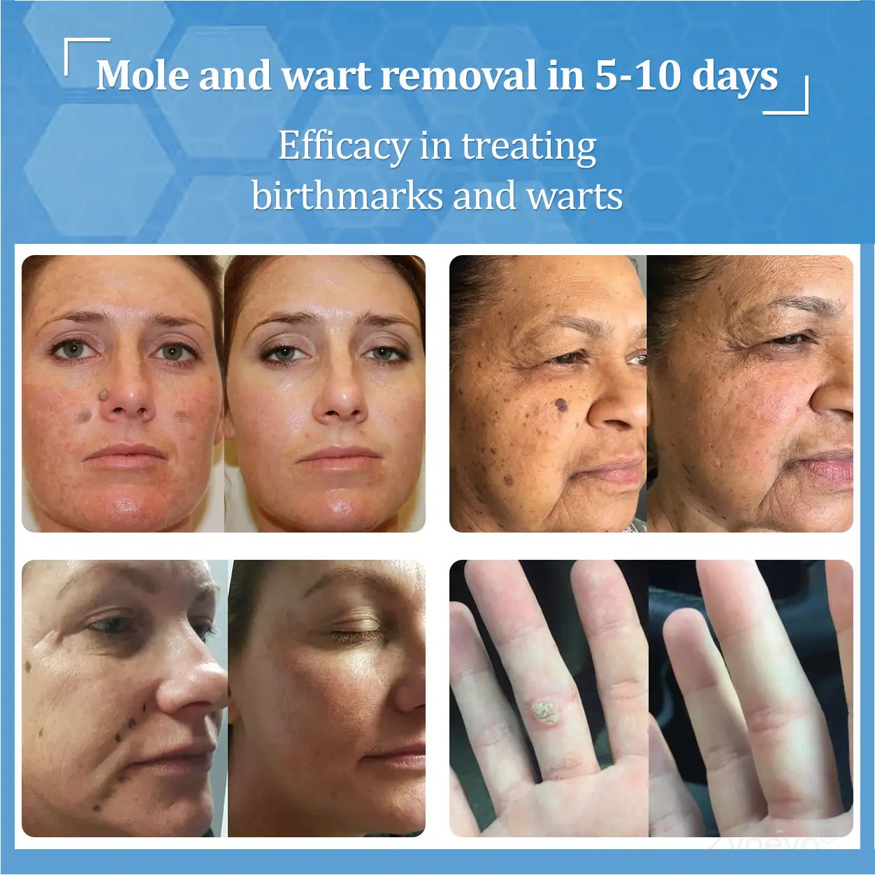 Zvoevo® BeeDerm RX Solution