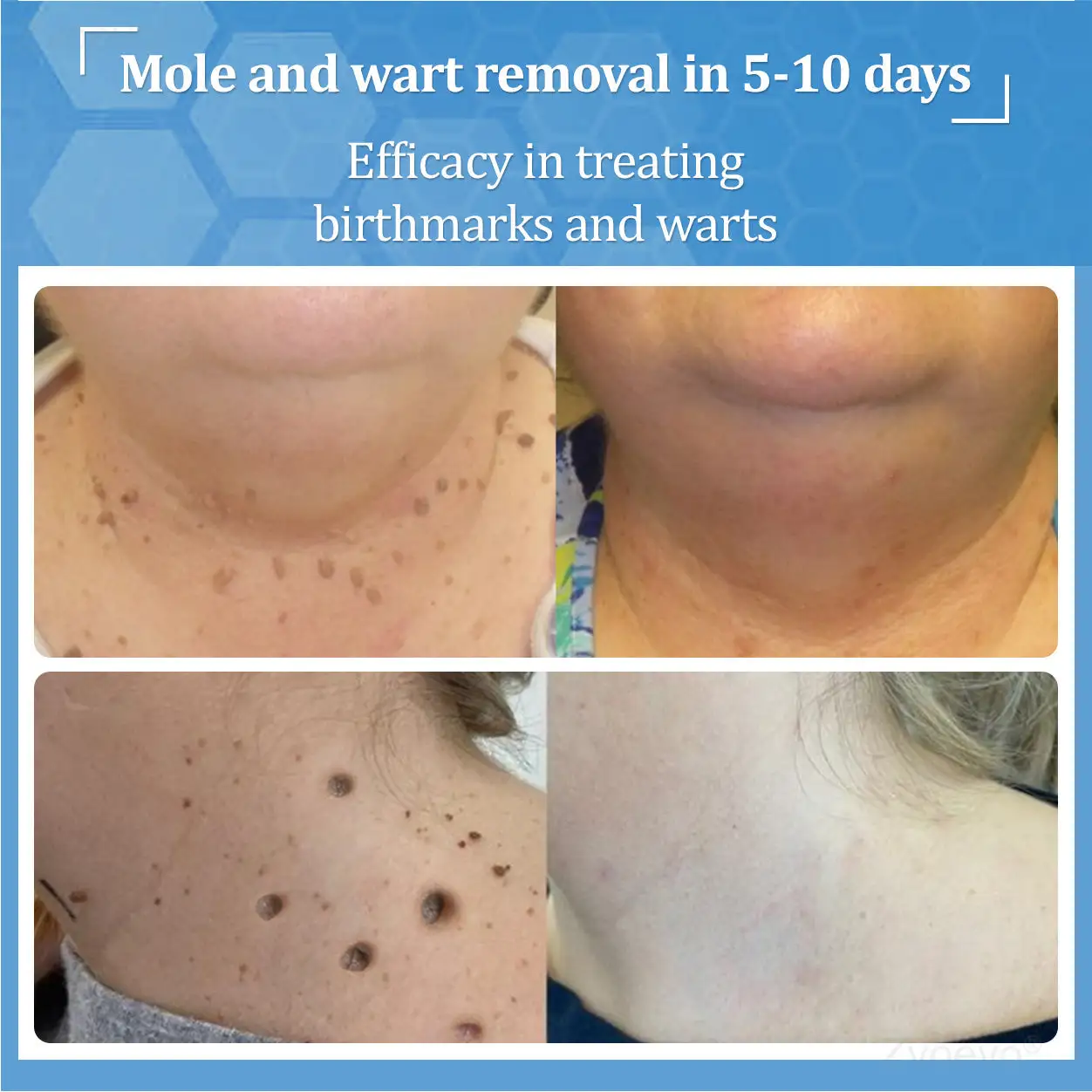 Zvoevo® BeeDerm RX Solution