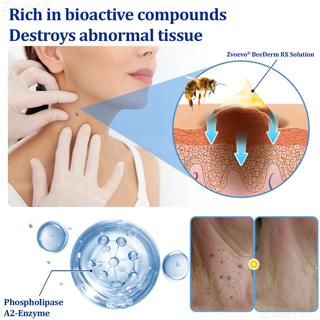 Zvoevo® BeeDerm RX Solution