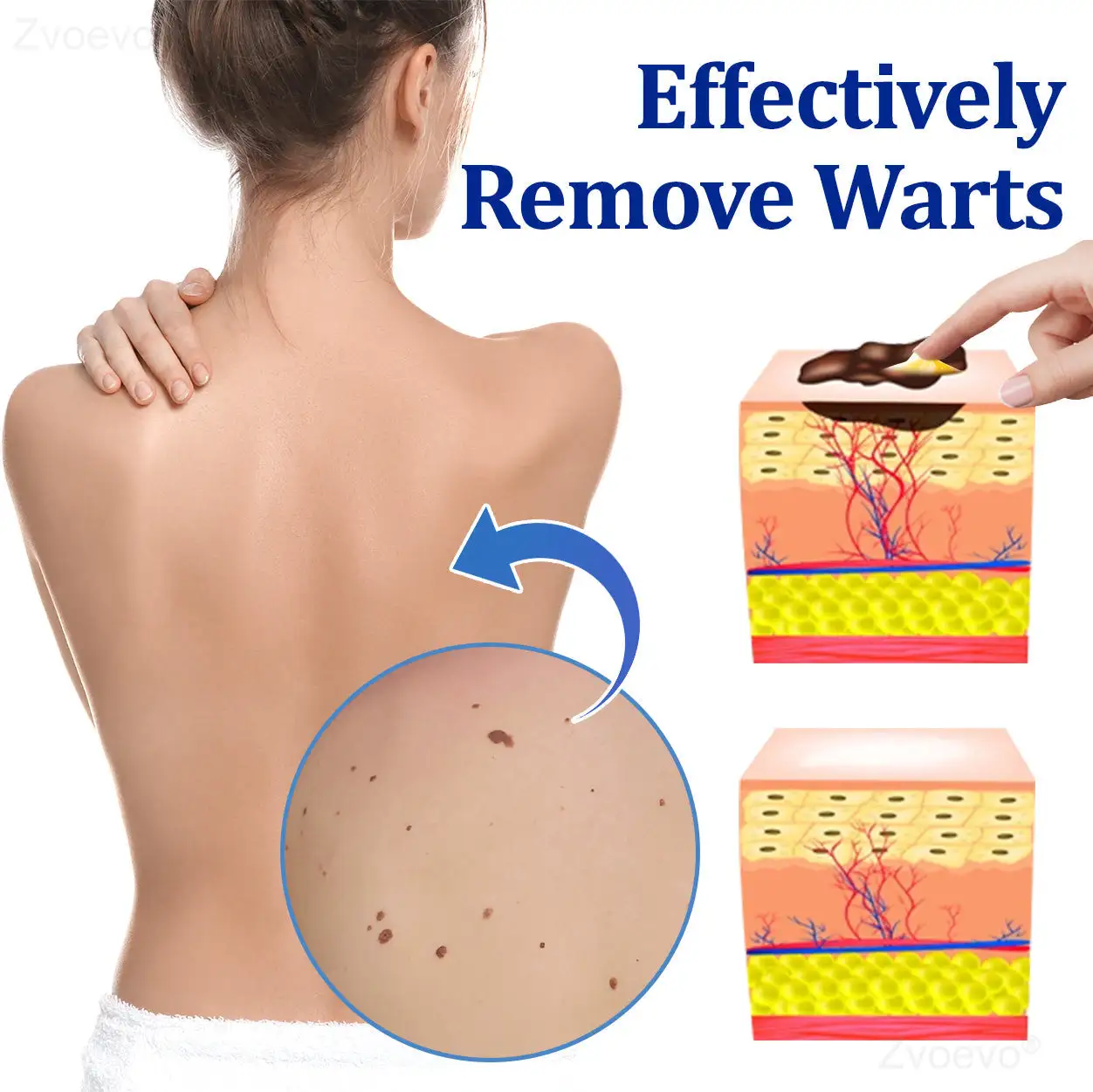 Zvoevo® BeeDerm RX Solution