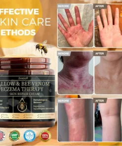 𝐙𝐯𝐨𝐞𝐯𝐨® 𝐓𝐚𝐥𝐥𝐨𝐰 & 𝐁𝐞𝐞 𝐕𝐞𝐧𝐨𝐦 𝐏𝐬𝐨𝐫𝐢𝐚𝐬𝐢𝐬 & 𝐄𝐜𝐳𝐞𝐦𝐚 𝐑𝐞𝐥𝐢𝐞𝐟 𝐂𝐫𝐞𝐚𝐦