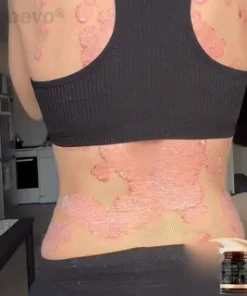 𝐙𝐯𝐨𝐞𝐯𝐨® 𝐏𝐬𝐨𝐫𝐢𝐚𝐬𝐢𝐬 & 𝐄𝐜𝐳𝐞𝐦𝐚 𝐑𝐞𝐥𝐢𝐞𝐟 𝐂𝐫𝐞𝐚𝐦