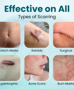 Zvoevo® Advanced Scar Gel for Surgical Scars