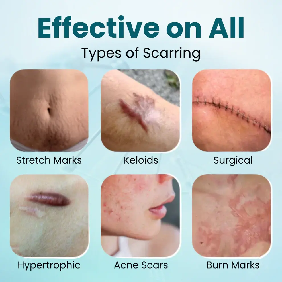 Zvoevo® Advanced Scar Gel for Surgical Scars
