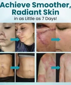 Zvoevo® Advanced Scar Gel for Surgical Scars