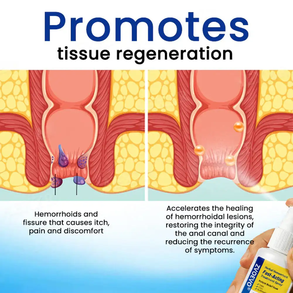 Zvoevo® Herbal Hemorrhoids Fast-Acting Treatment Spray