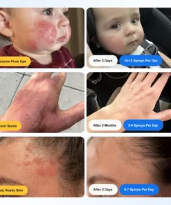 𝐙𝐯𝐨𝐞𝐯𝐨® 𝐇𝐲𝐩𝐨𝐜𝐡𝐥𝐨𝐫𝐨𝐮𝐬 𝐀𝐜𝐢𝐝 𝐒𝐩𝐫𝐚𝐲