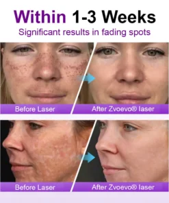 𝐳𝐯𝐨𝐞𝐯𝐨® 𝐒𝐩𝐨𝐭𝐄𝐫𝐚𝐬𝐞 𝐏𝐫𝐨𝐛𝐢𝐨𝐭𝐢𝐜 𝐒𝐡𝐢𝐞𝐥𝐝 𝐒𝐞𝐫𝐮𝐦