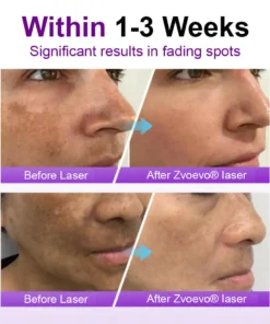 𝐳𝐯𝐨𝐞𝐯𝐨® 𝐒𝐩𝐨𝐭𝐄𝐫𝐚𝐬𝐞 𝐏𝐫𝐨𝐛𝐢𝐨𝐭𝐢𝐜 𝐒𝐡𝐢𝐞𝐥𝐝 𝐒𝐞𝐫𝐮𝐦